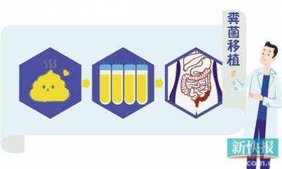 奇招（zhāo）！“糞菌移植” 救（jiù）了潰瘍性結腸炎患者