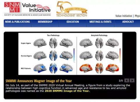 “超級老人”的大腦為何能抵禦阿爾茨海默(mò)病
